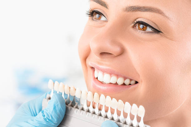 Fațetele dentare – ce trebuie să știi despre această procedură